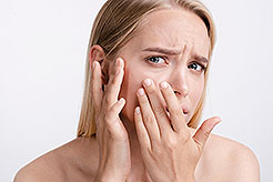 ACNÉ: ¿Qué es el acné? ¿Hay que tratarlo o es algo normal?